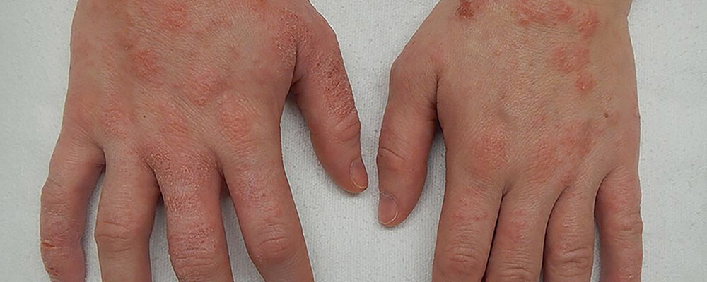 Homeopatija u lečenju kožnih bolesti