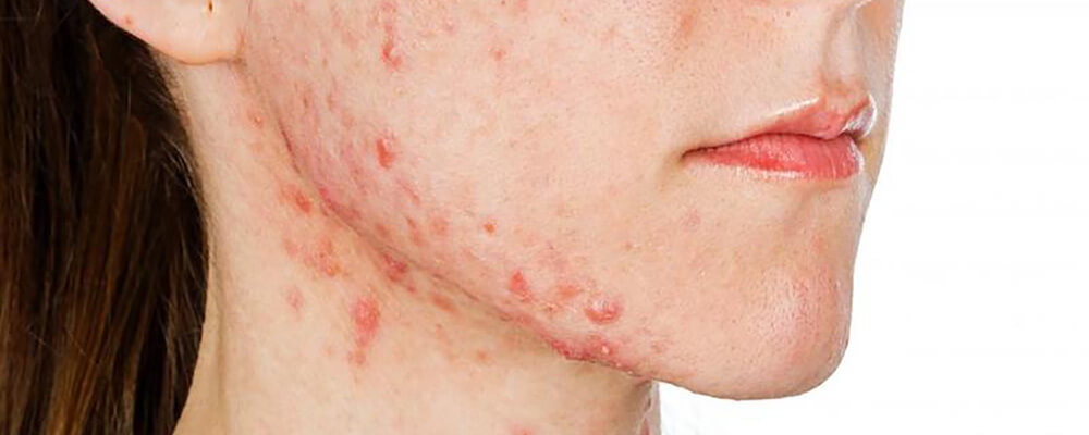 Akne