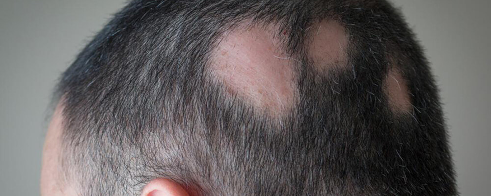Alopecija